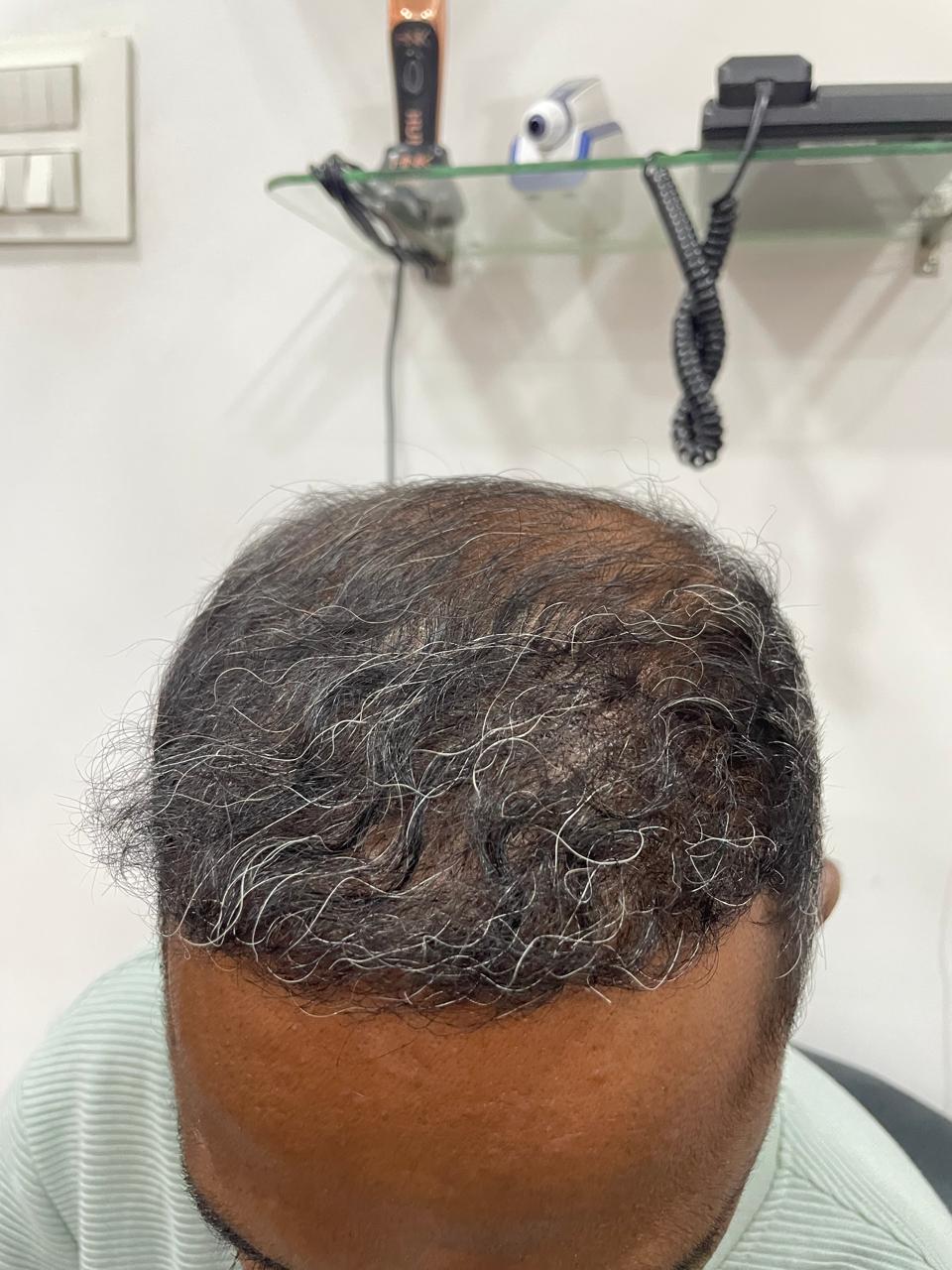 After - Hair Regrowth